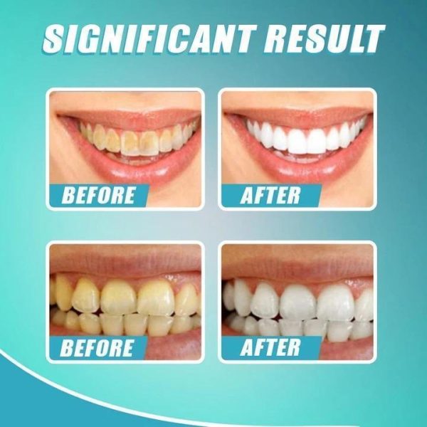 【LAST DAY PROMOTION】 - Intensive Stain Removal Teeth Whitening Toothpaste Online - Image 5